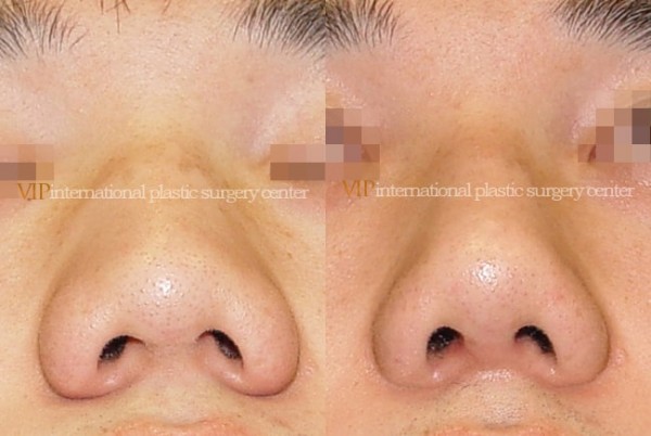 	Nose Surgery	 - Wide nasal bone reduction rhinoplasty