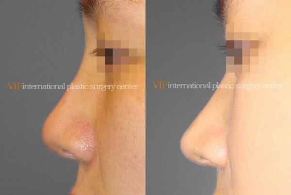 Nose Surgery - Septal cartilage rhinoplasty