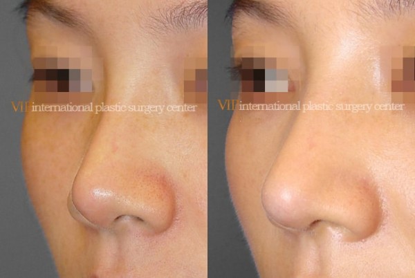 Nose Surgery - Septal cartilage rhinoplasty