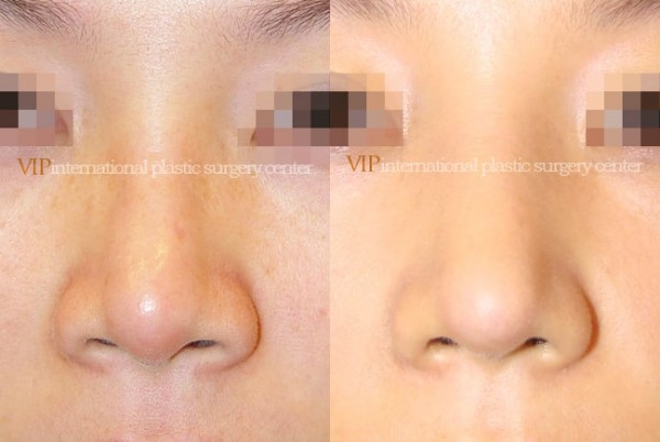 Nose Surgery - Septal cartilage rhinoplasty