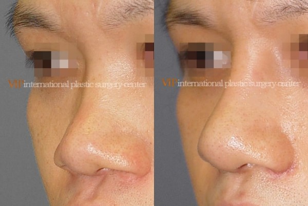 Nose Surgery - Alar base reduction