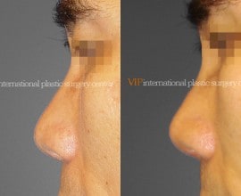 Nostril correction