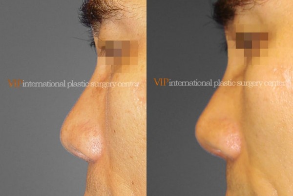 Nose Surgery - Nostril correction