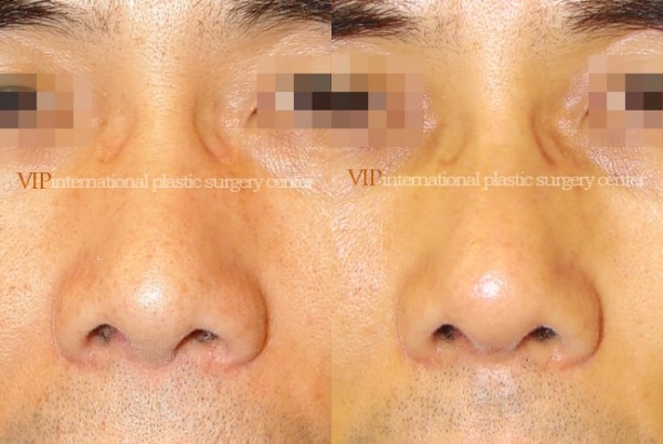 Nose Surgery - Nostril correction