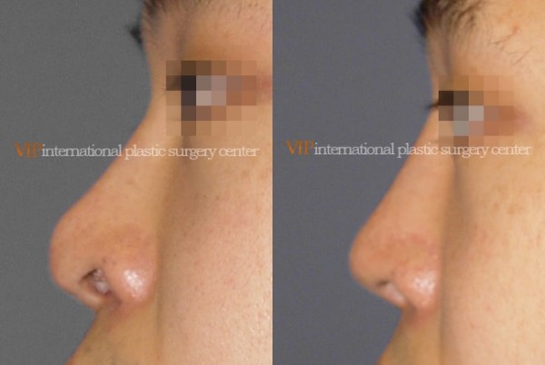 	Nose Surgery	 - Nostril correction