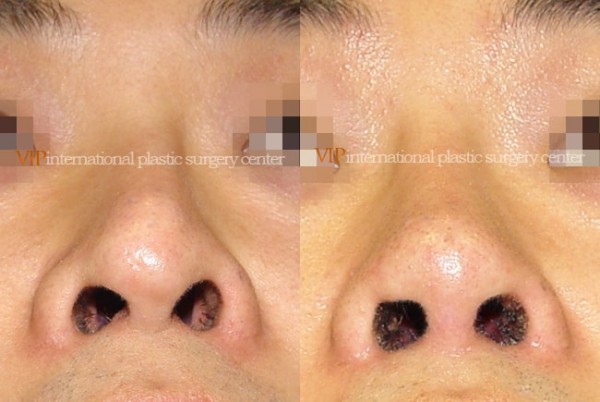 	Nose Surgery	 - Nostril correction