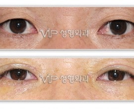 Upper & Lower blepharoplasty