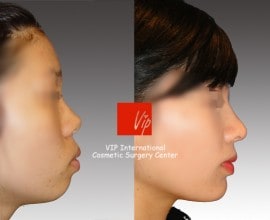 VIP Harmony rhinoplasty ( small, upturned & protruded mouth …