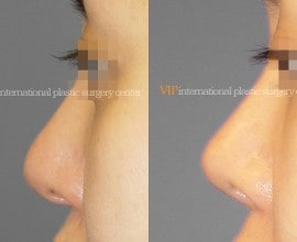 Long and Bulbous nose correction