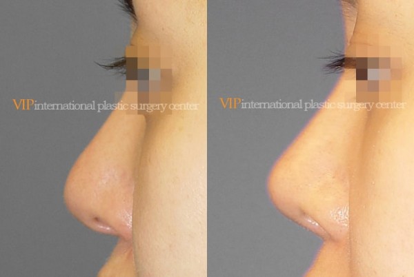 	Nose Surgery	 - Long and Bulbous nose correction