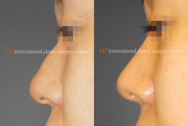 Nose Surgery - Rhinoplasty