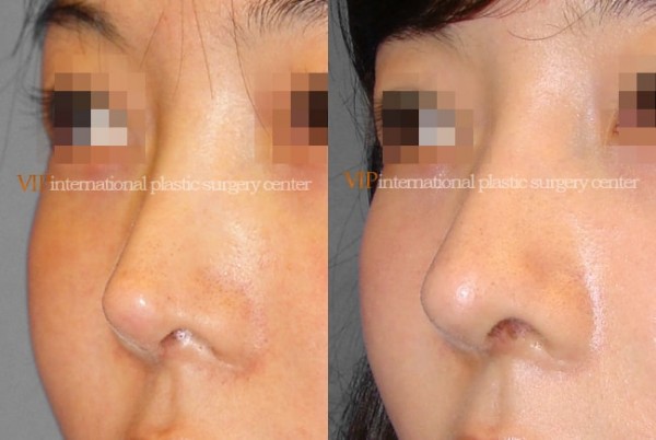 	Nose Surgery, Revision Rhinoplasty	 - Silicone showing nose