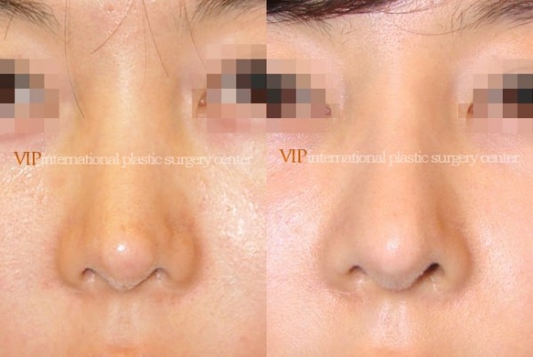 	Nose Surgery, Revision Rhinoplasty	 - Silicone showing nose