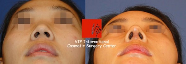 	Harmony-Rhinoplasty, Protruded Mouth Correction Rhinoplasty, Rib cartilage Rhinoplasty	 - Harmony rhinoplasty