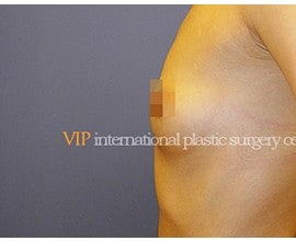 Breast surgery