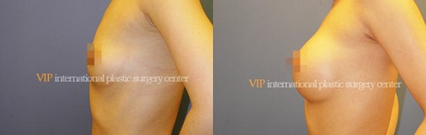 Breast Surgery - Breast surgery