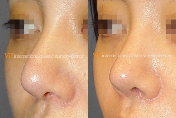 	Nose Surgery	 - Long and Bulbous nose correction