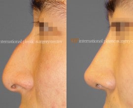 Nose bridge correction