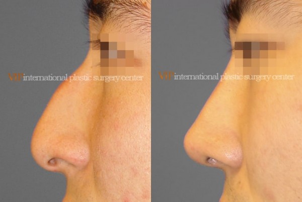 Nose Surgery - Nose bridge correction