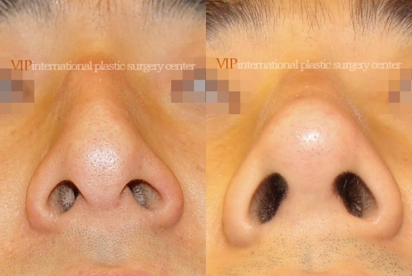 Nose Surgery - Nose bridge correction