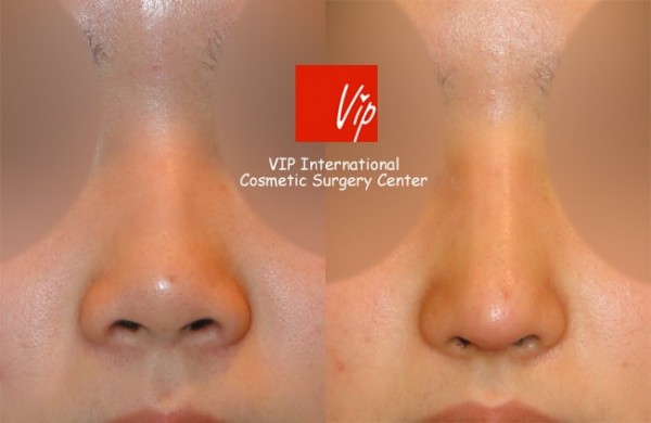 	Nose Surgery, Rib cartilage Rhinoplasty, Each Cases Nose	 - Short & Flat nose - Rib cartilage rhinoplasty