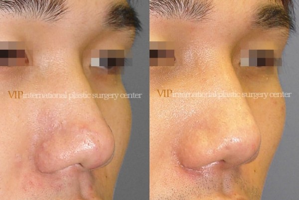 	Nose Surgery	 - Wide nasal bone reduction rhinoplasty