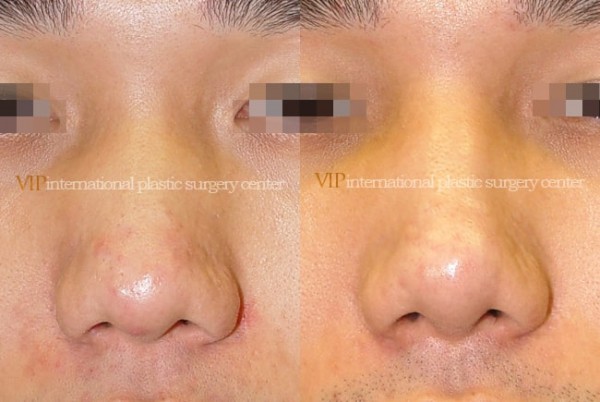 	Nose Surgery	 - Wide nasal bone reduction rhinoplasty