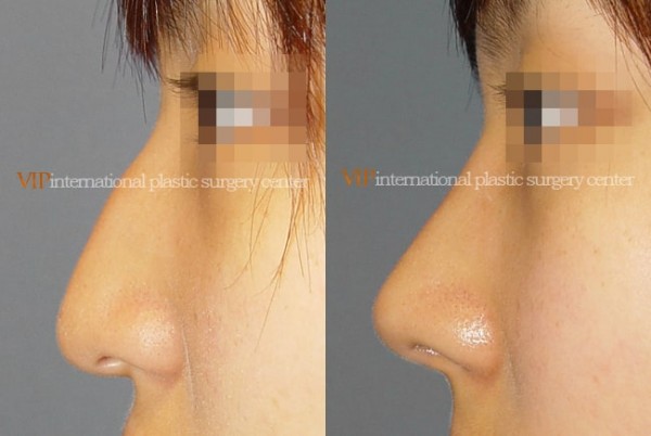 Nose Surgery - Nose bridge correction