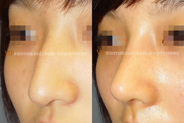 Nose Surgery - Nose bridge correction