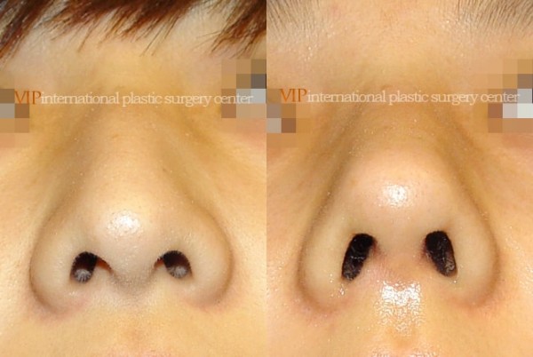 Nose Surgery - Nose bridge correction