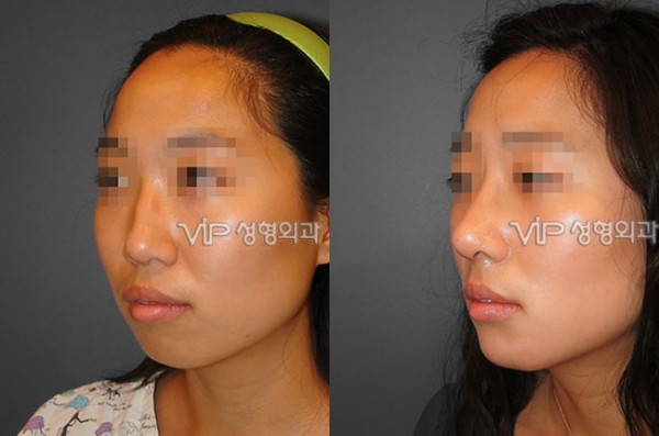 	Harmony-Rhinoplasty, Protruded Mouth Correction Rhinoplasty, Rib cartilage Rhinoplasty	 - VIP Harmony rhinoplasty