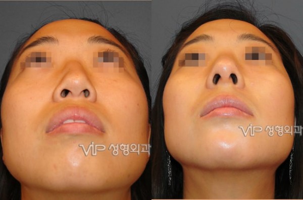	Harmony-Rhinoplasty, Protruded Mouth Correction Rhinoplasty, Rib cartilage Rhinoplasty	 - VIP Harmony rhinoplasty