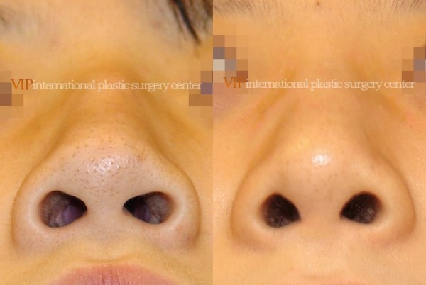 Nose Surgery - Nose bridge correction