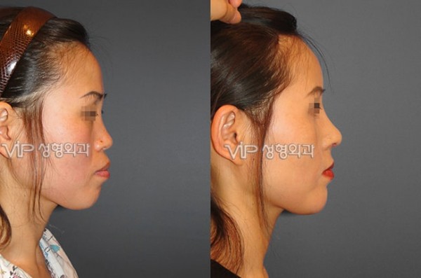 Nose Surgery - VIP Harmony rhinoplasty