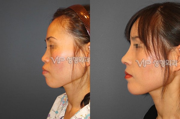 Nose Surgery - VIP Harmony rhinoplasty
