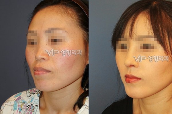 Nose Surgery - VIP Harmony rhinoplasty