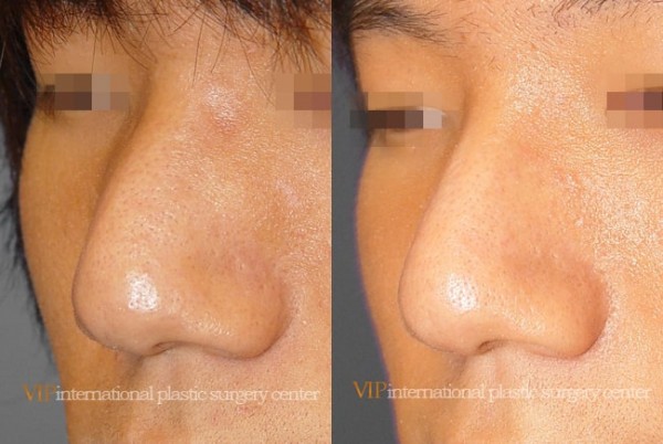 	Nose Surgery	 - Wide nasal bone reduction rhinoplasty