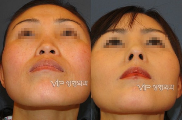 Nose Surgery - VIP Harmony rhinoplasty