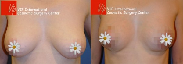 Breast Surgery - Breast reduction