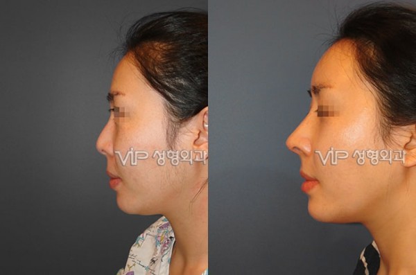	Rib cartilage Rhinoplasty, Contracted Nose, Revision Rhinoplasty	 - Rib cartilage rhinoplasty
