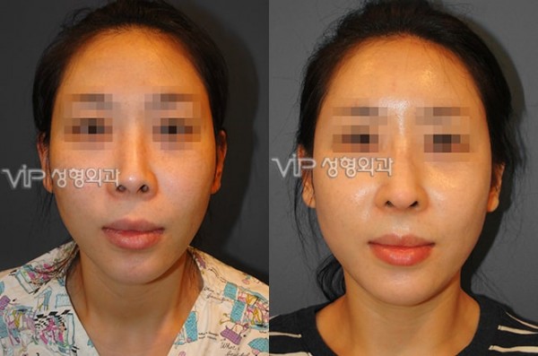 	Rib cartilage Rhinoplasty, Contracted Nose, Revision Rhinoplasty	 - Rib cartilage rhinoplasty