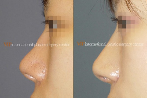 Nose Surgery - Nostril correction