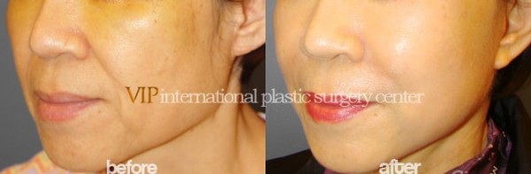 Face Lift - Wrinkle surgery