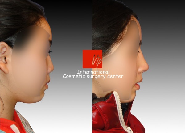 	Nose Surgery, Rib cartilage Rhinoplasty, Each Cases Nose	 - Short & Flat nose - Rib cartilage rhinoplasty