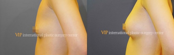 	Breast Surgery, Body Contouring	 - Breast surgery