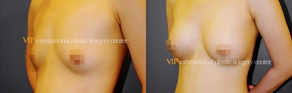 	Breast Surgery, Body Contouring	 - Breast surgery