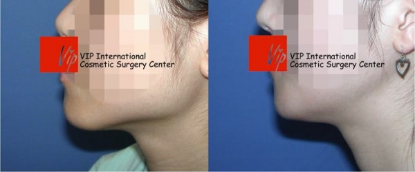 	Facial Bone Surgery	 - Square jaw reduction surgery