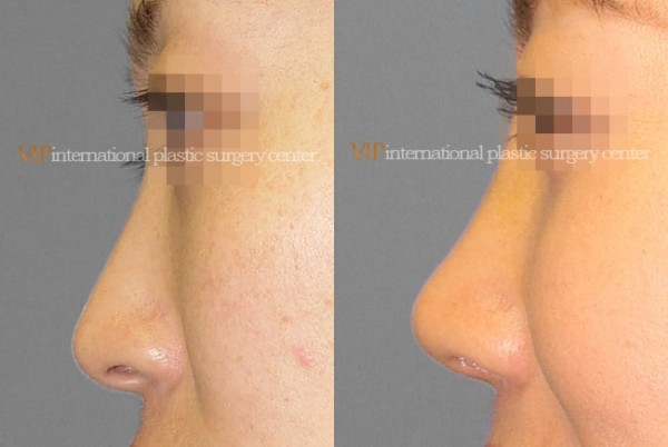 Nose Surgery - Septal cartilage rhinoplasty