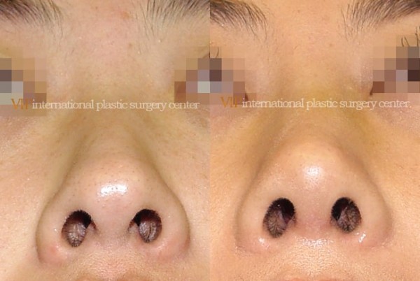 Nose Surgery - Septal cartilage rhinoplasty