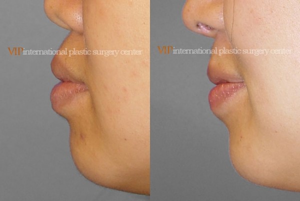 Facial Bone Surgery - Protruded mouth correction
